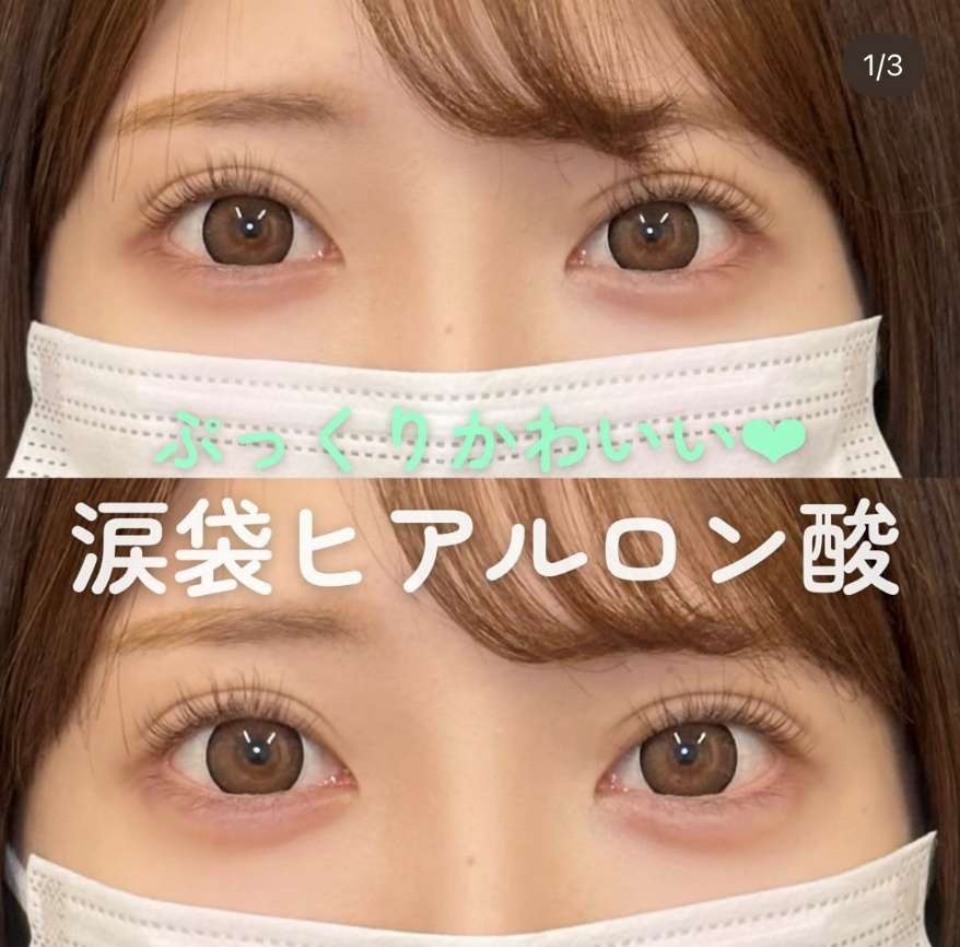 涙袋ヒアルロン酸の症例写真