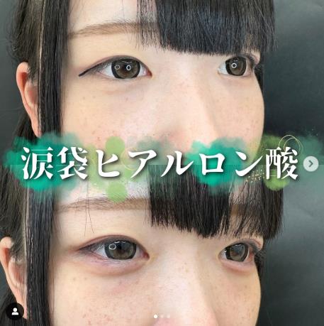 涙袋ヒアルロン酸の症例写真