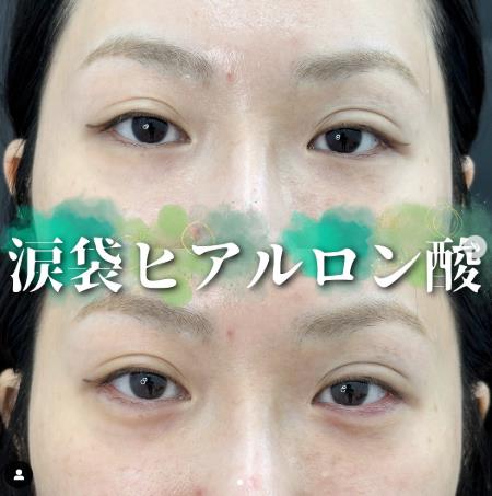 涙袋ヒアルロン酸の症例写真