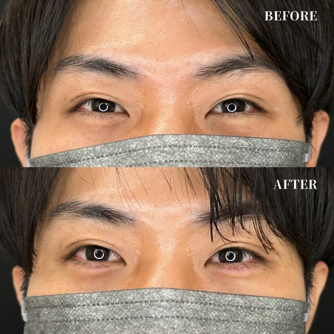 涙袋ヒアルロン酸の症例写真