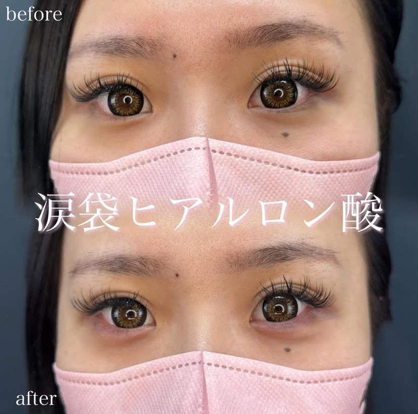 涙袋ヒアルロン酸の症例写真