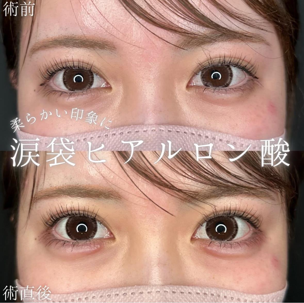 涙袋ヒアルロン酸の症例写真