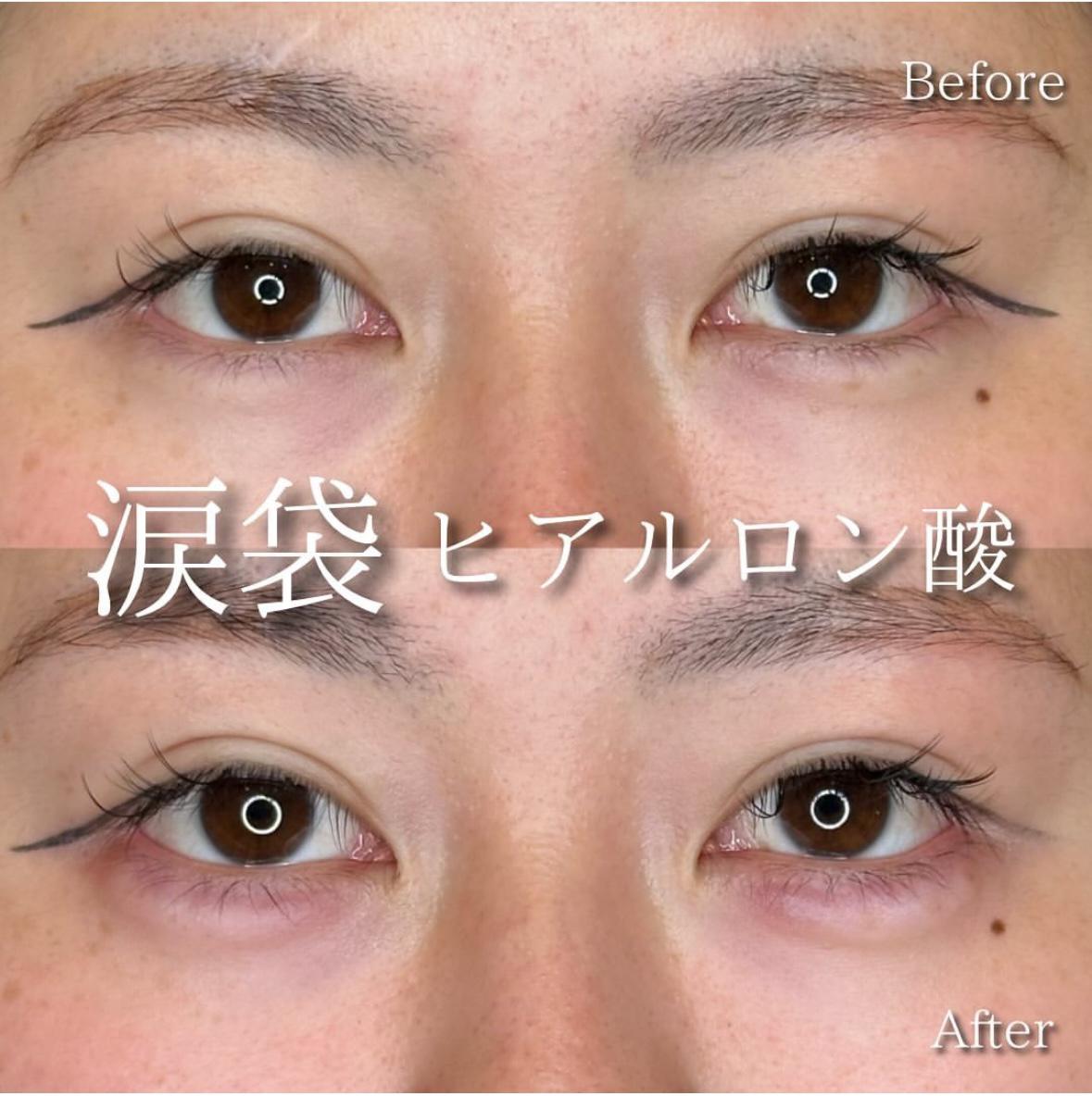 涙袋ヒアルロン酸の症例写真