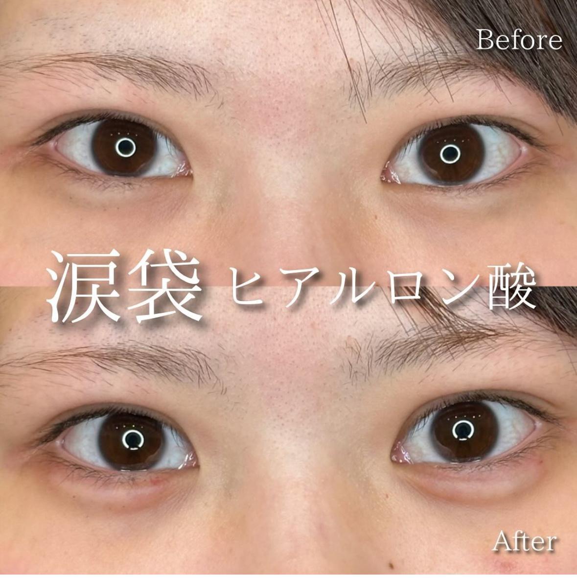 涙袋ヒアルロン酸の症例写真