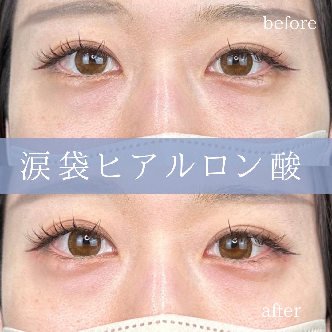 涙袋ヒアルロン酸の症例写真