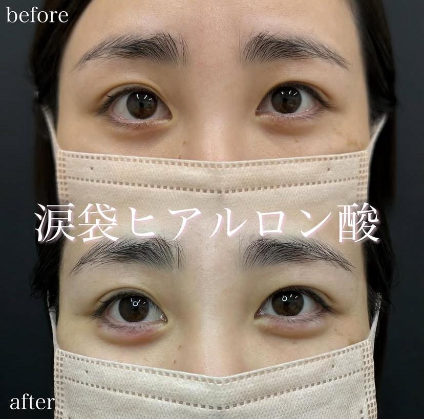涙袋ヒアルロン酸の症例写真