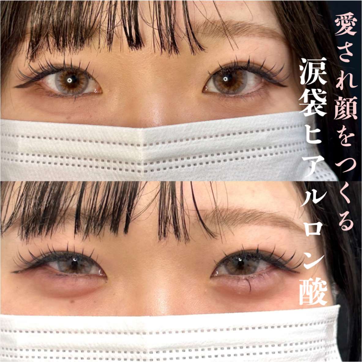 涙袋ヒアルロン酸の症例写真