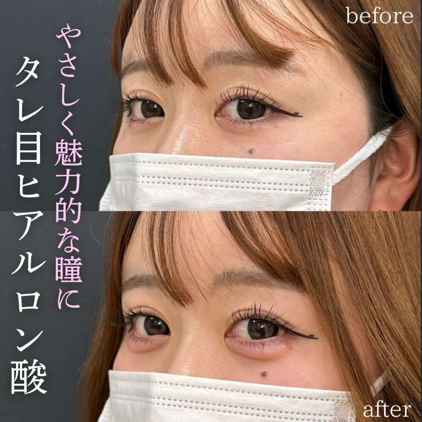 涙袋ヒアルロン酸の症例写真