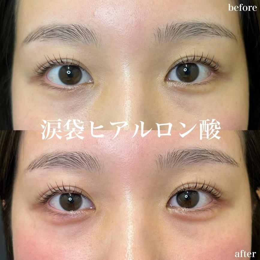 涙袋ヒアルロン酸の症例写真
