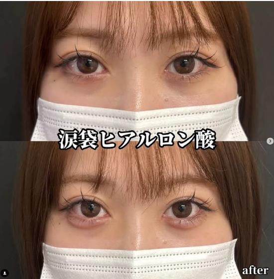 涙袋ヒアルロン酸の症例写真