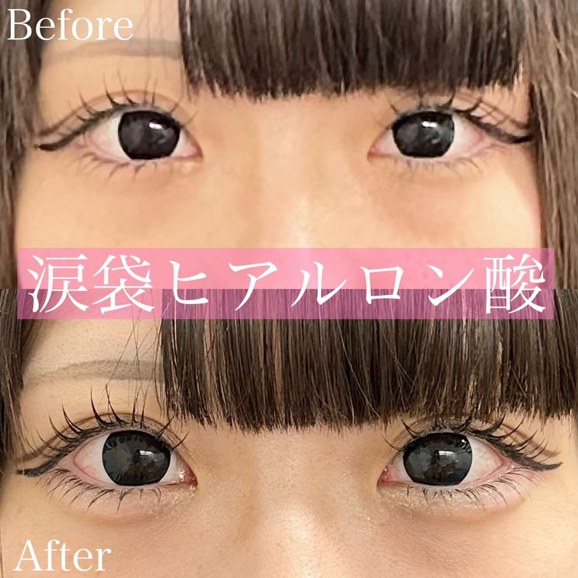 涙袋ヒアルロン酸の症例写真