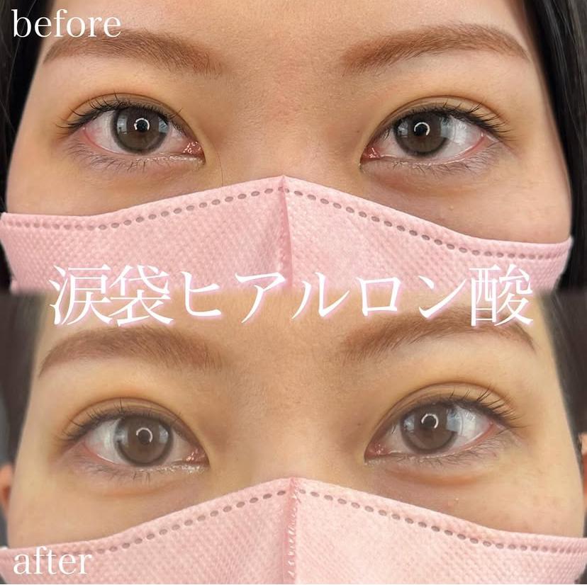 涙袋ヒアルロン酸の症例写真