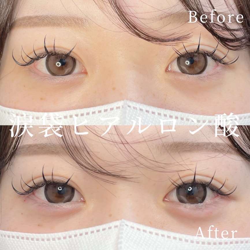 涙袋ヒアルロン酸の症例写真