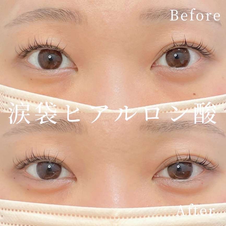 涙袋ヒアルロン酸の症例写真