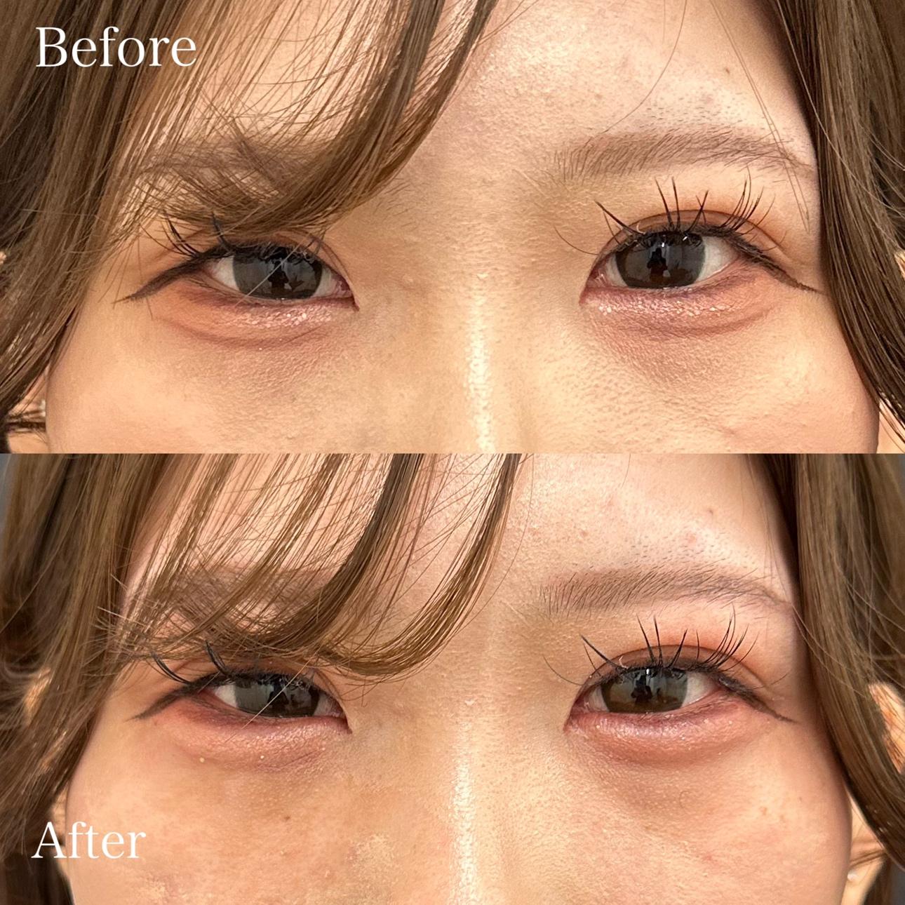 涙袋ヒアルロン酸の症例写真