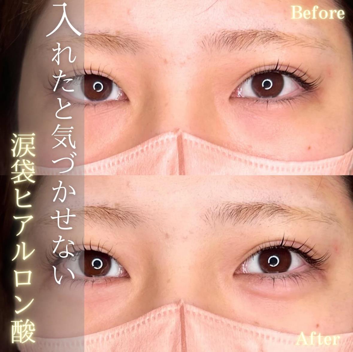 涙袋ヒアルロン酸の症例写真