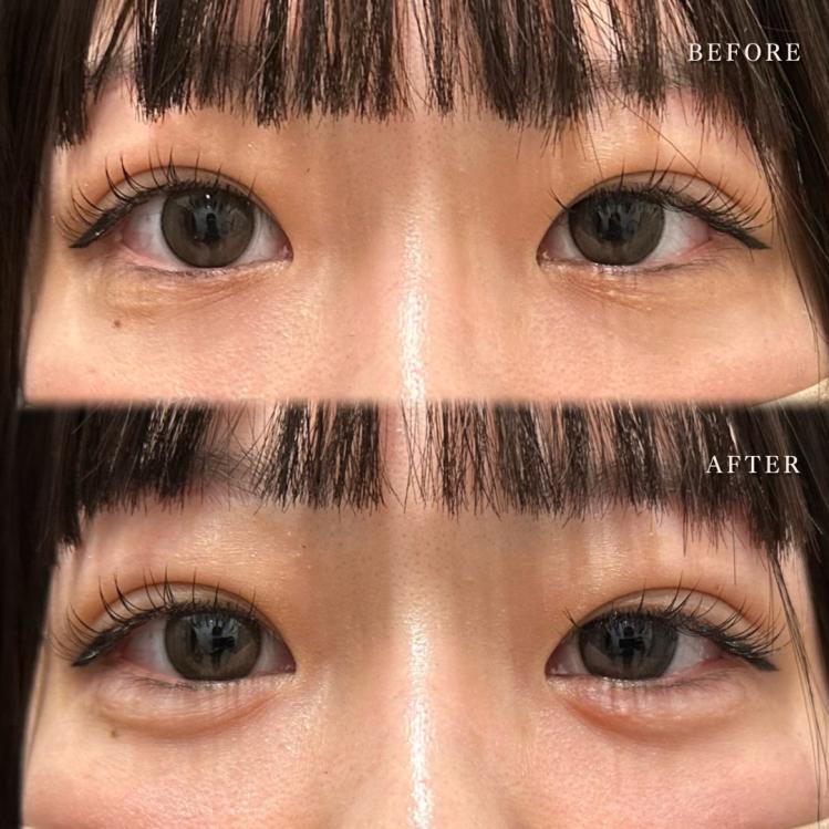 涙袋ヒアルロン酸の症例写真