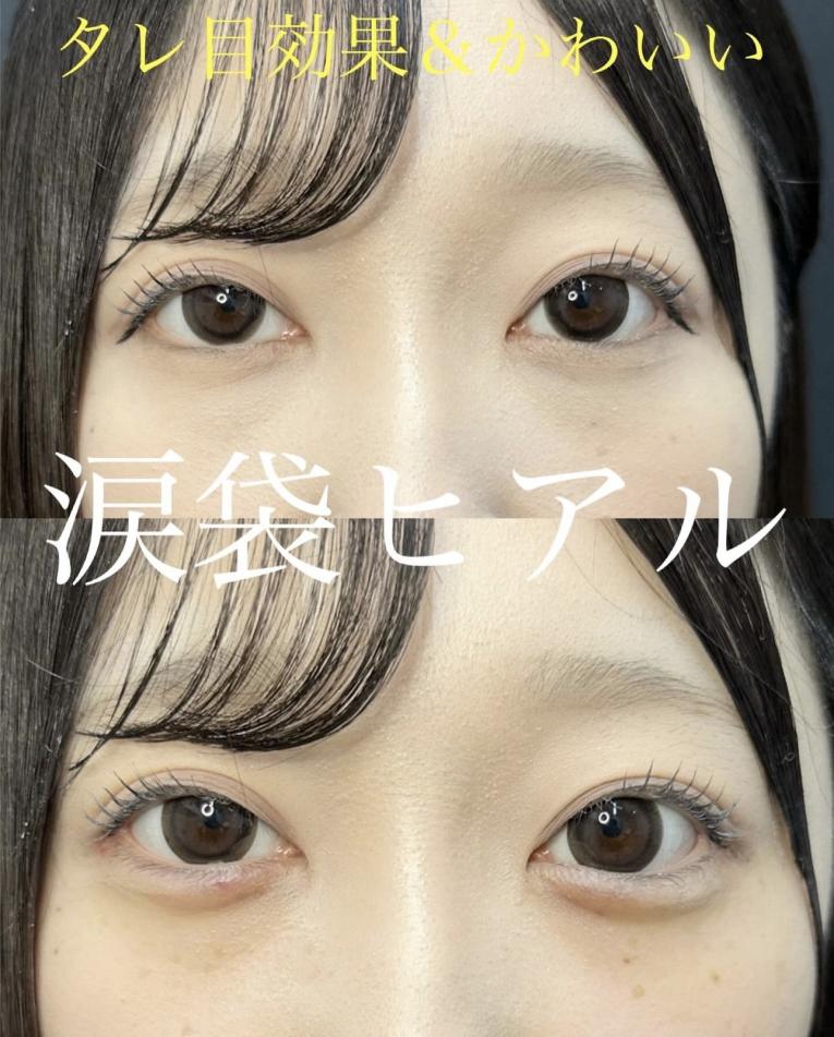 涙袋ヒアルロン酸の症例写真