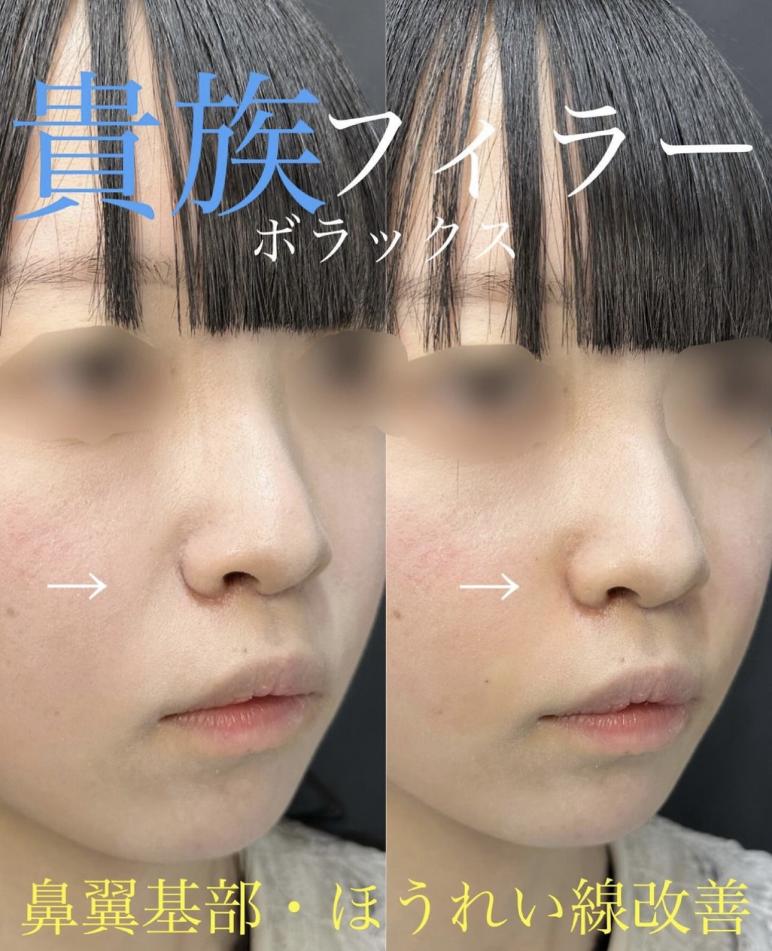涙袋ヒアルロン酸の症例写真