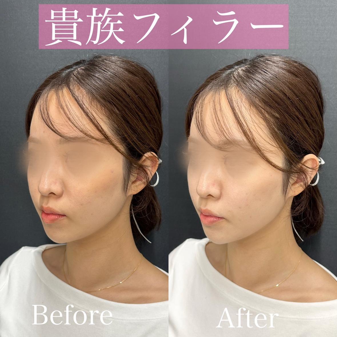 涙袋ヒアルロン酸の症例写真