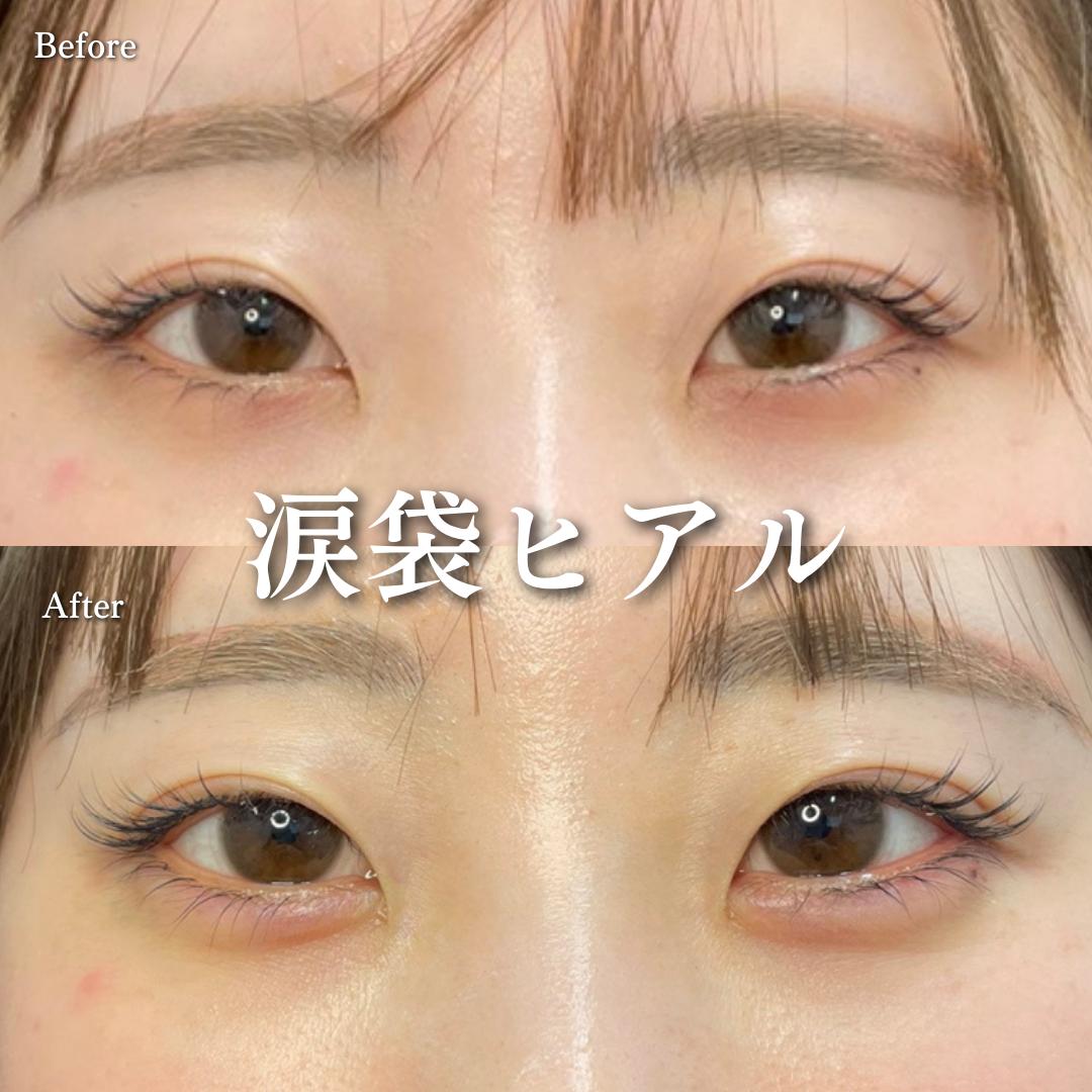 涙袋ヒアルロン酸の症例写真