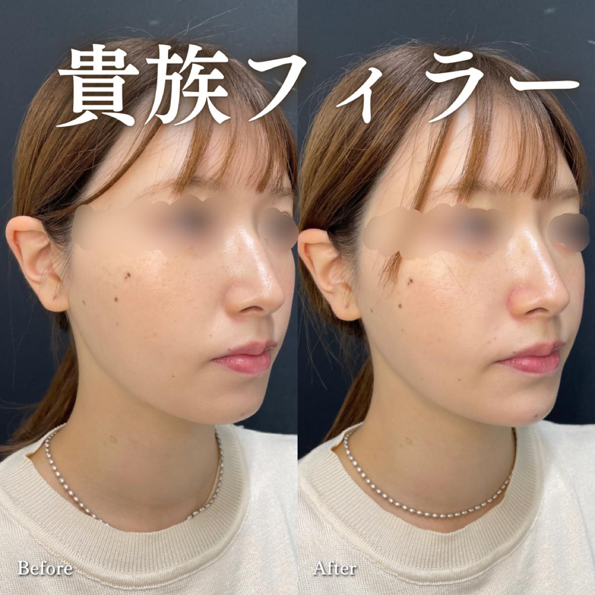 涙袋ヒアルロン酸の症例写真