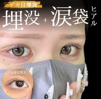涙袋ヒアルロン酸の症例写真