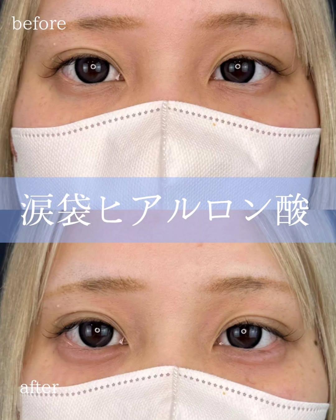 涙袋ヒアルロン酸の症例写真