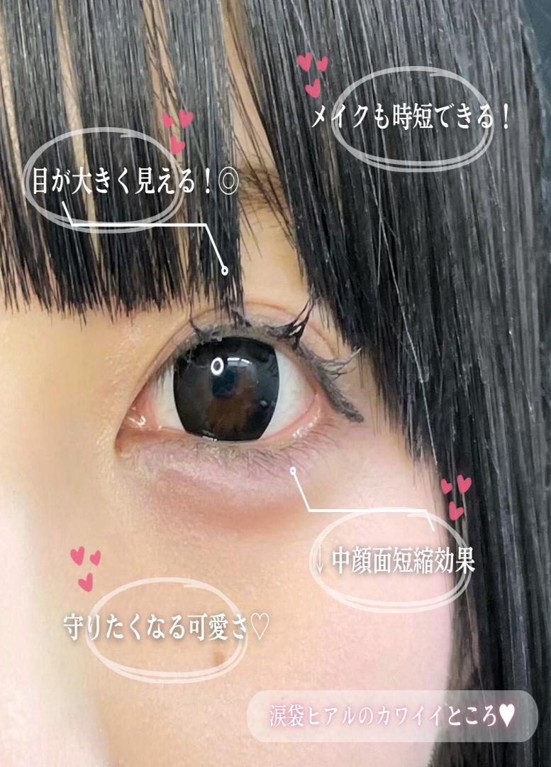 涙袋ヒアルロン酸の症例写真
