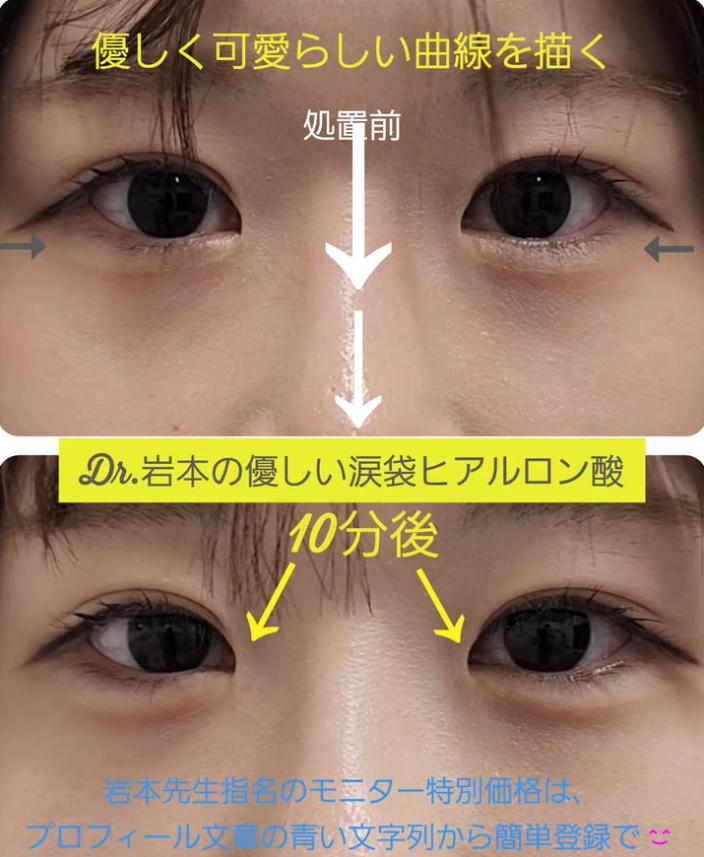 涙袋ヒアルロン酸の症例写真
