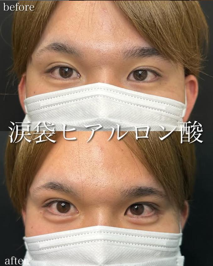 涙袋ヒアルロン酸の症例写真