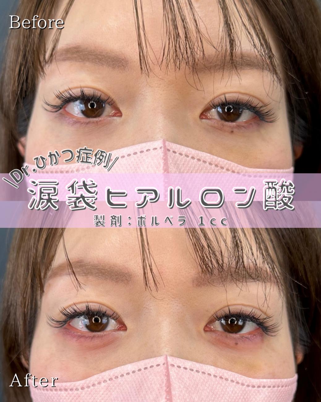 涙袋ヒアルロン酸の症例写真