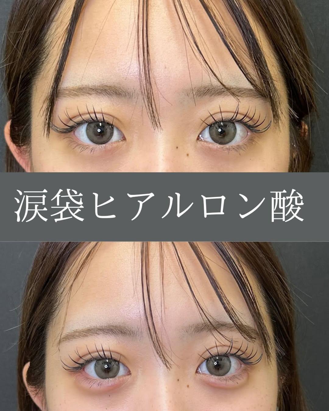 涙袋ヒアルロン酸の症例写真