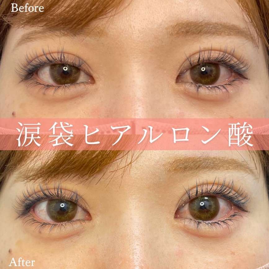 涙袋ヒアルロン酸の症例写真