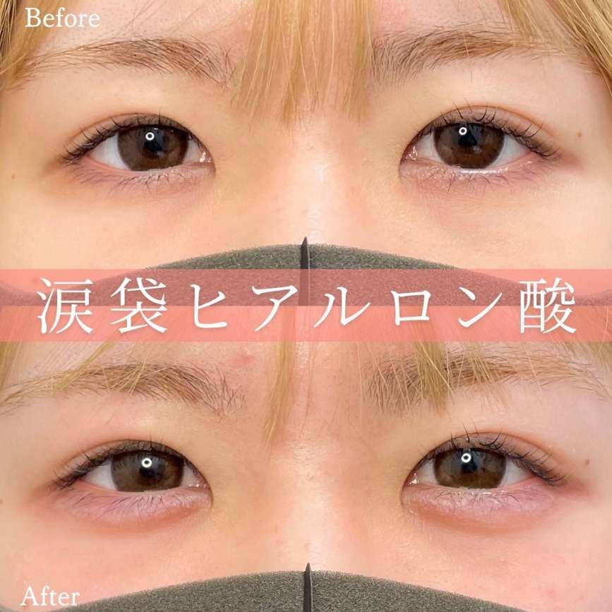 涙袋ヒアルロン酸の症例写真