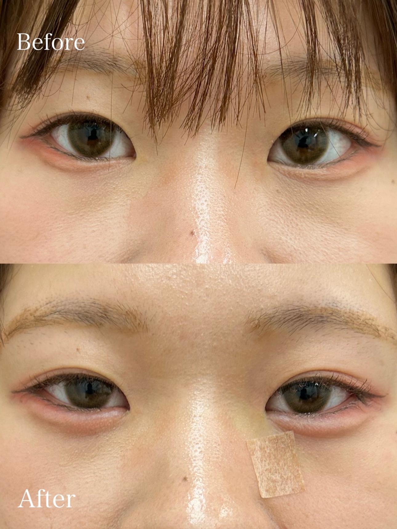 涙袋ヒアルロン酸の症例写真