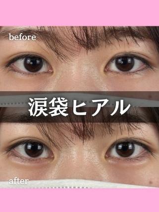 涙袋ヒアルロン酸の症例写真