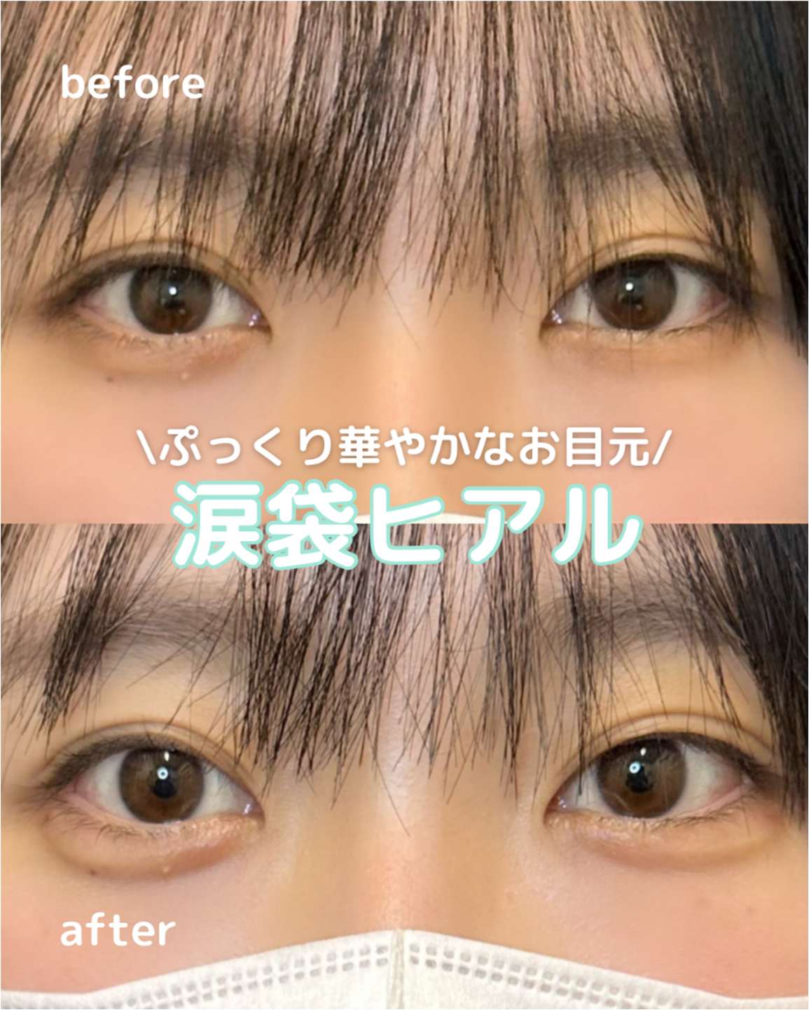 涙袋ヒアルロン酸の症例写真