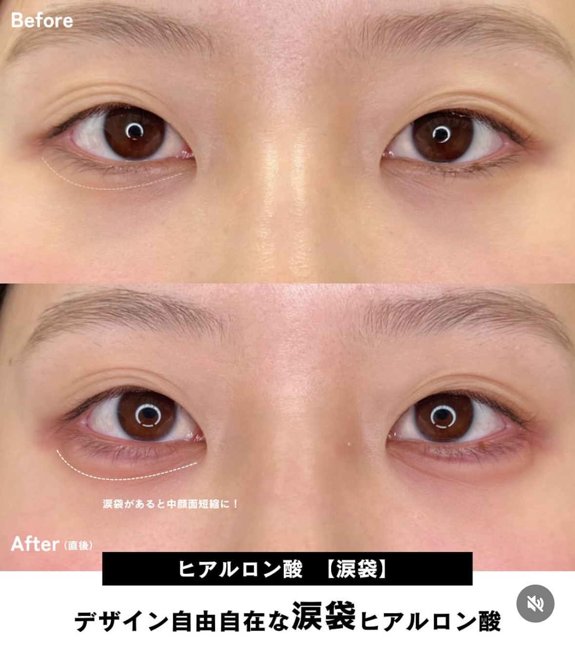 涙袋ヒアルロン酸の症例写真