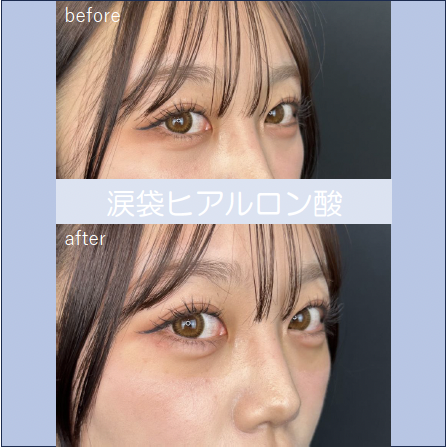 涙袋ヒアルロン酸の症例写真