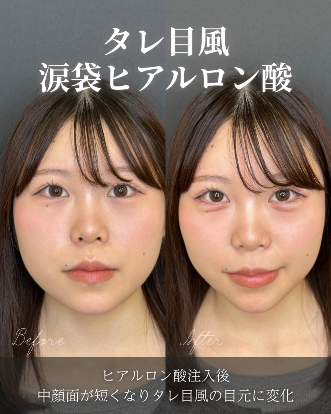 涙袋ヒアルロン酸の症例写真