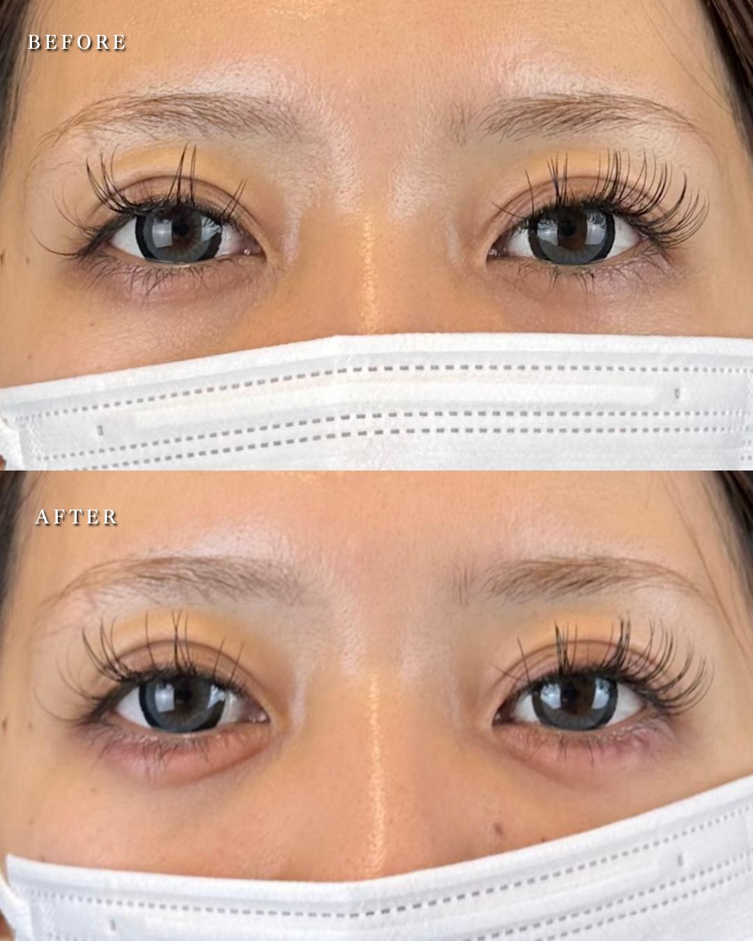 涙袋ヒアルロン酸の症例写真