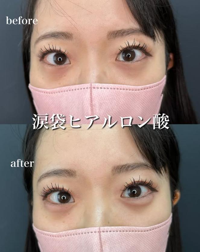 涙袋ヒアルロン酸の症例写真