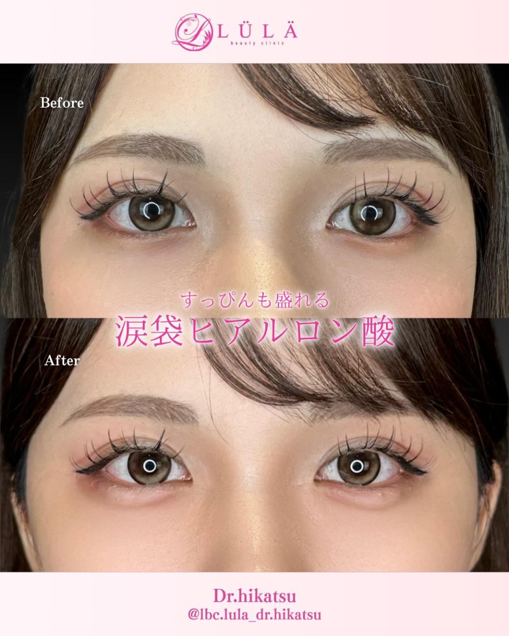 涙袋ヒアルロン酸の症例写真