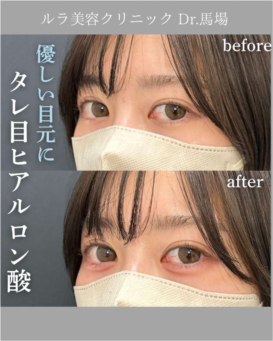 涙袋ヒアルロン酸の症例写真