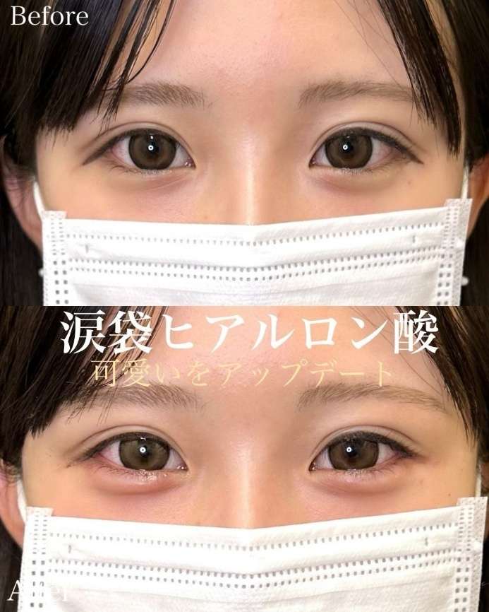 涙袋ヒアルロン酸の症例写真