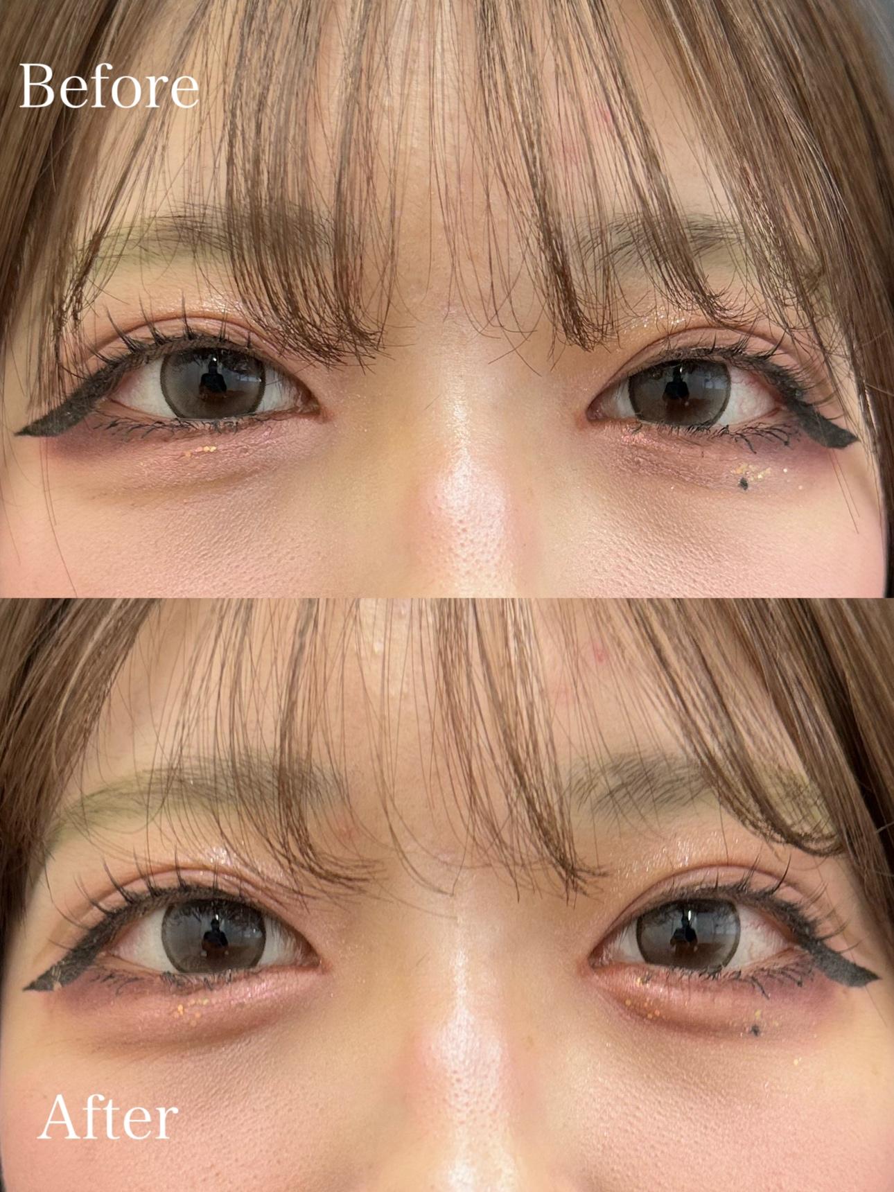 涙袋ヒアルロン酸の症例写真