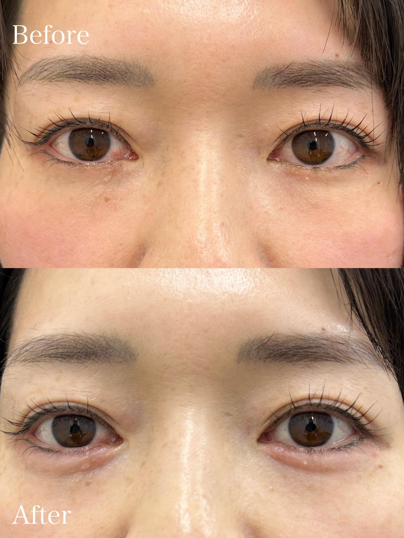 涙袋ヒアルロン酸の症例写真