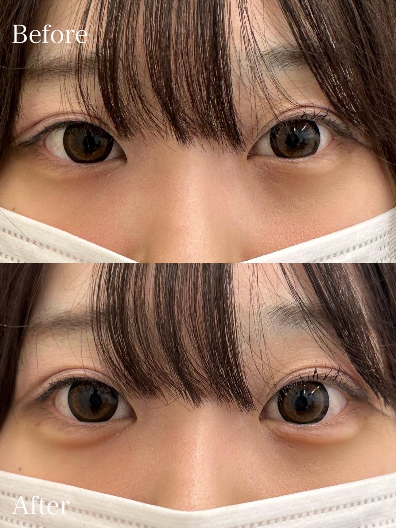 涙袋ヒアルロン酸の症例写真