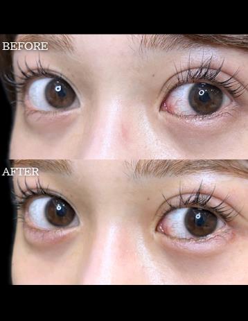 涙袋ヒアルロン酸の症例写真